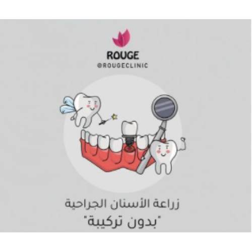 زراعة الأسنان الجراحية بدون تركيبة زراعة الأسنان الجراحية بدون تركيبة