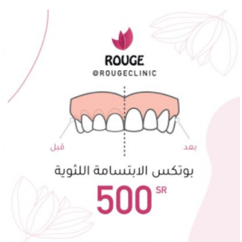 بوتكس الابتسامة اللثوية